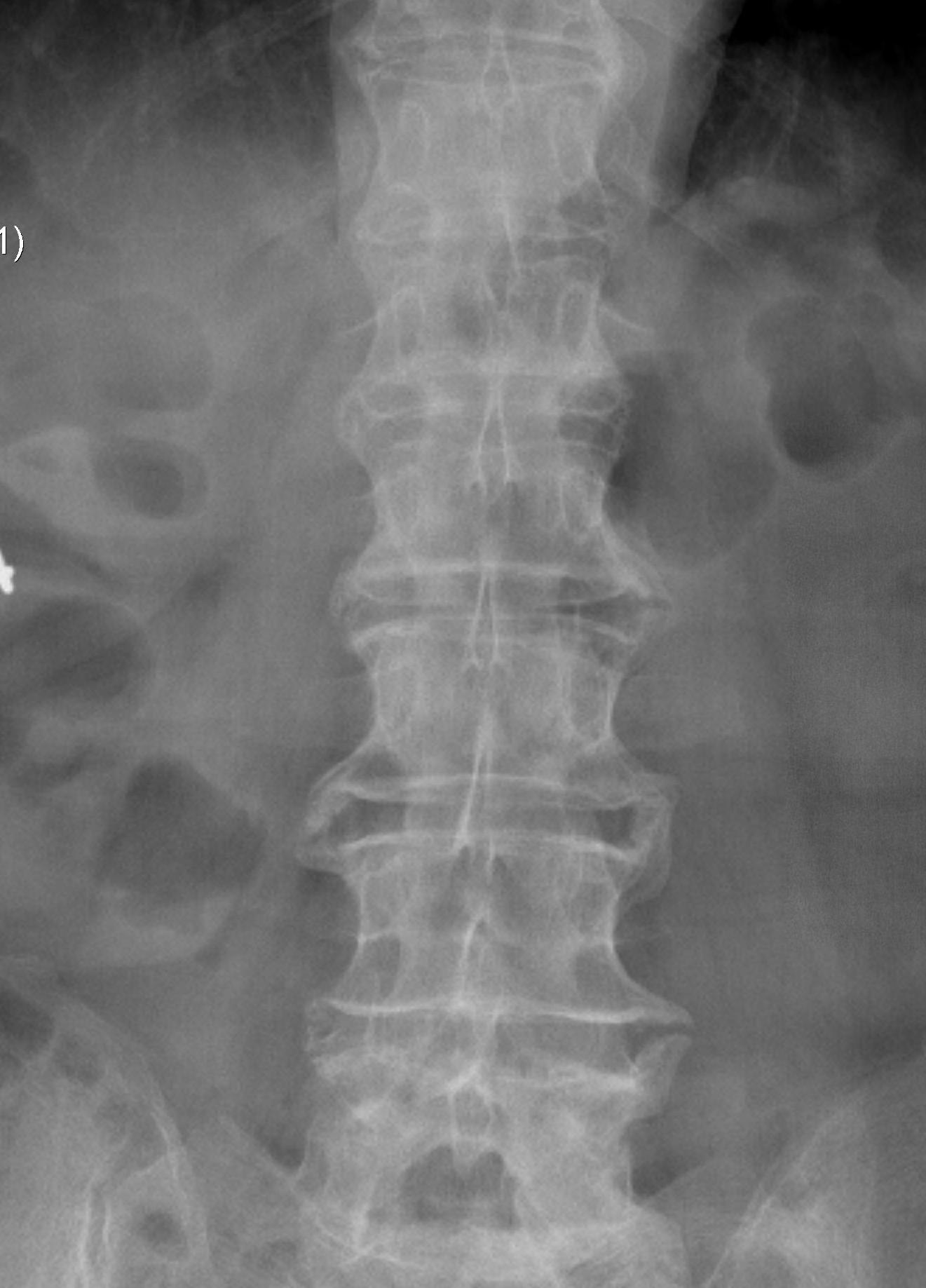 Ankylosing Spondylitis Marginal Syndesmophytes